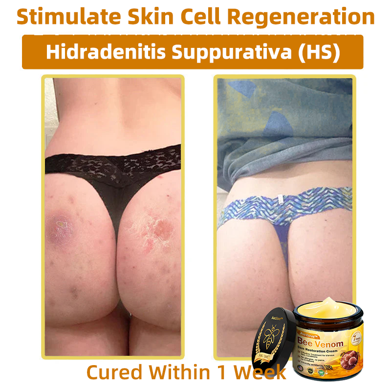 Mayo Clinic Official: Awzlove™ Powerful All-Body Skin Treatment Cream Anti-aging, Hydrating, Skin Repair, Even Tone, Acne and Dark Spot Treatment, Wart and Mole Removal, Psoriasis Relief (Suitable for all ages & AAD recommends) 💌