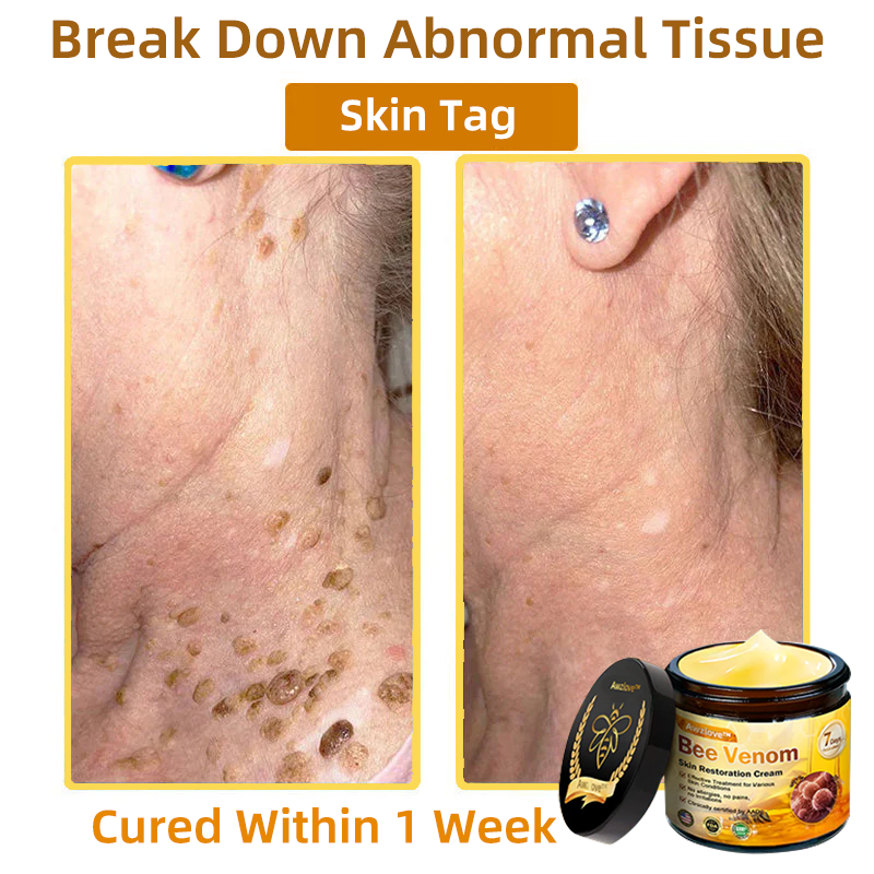 Mayo Clinic Official: Awzlove™ Powerful All-Body Skin Treatment Cream Anti-aging, Hydrating, Skin Repair, Even Tone, Acne and Dark Spot Treatment, Wart and Mole Removal, Psoriasis Relief (Suitable for all ages & AAD recommends) 💌