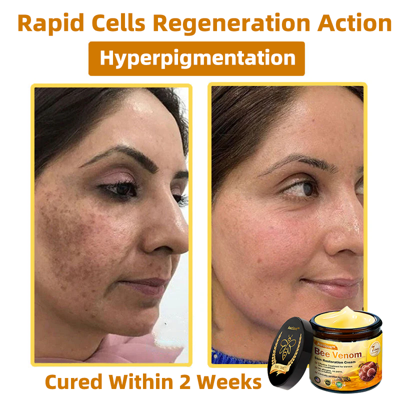 Mayo Clinic Official: Awzlove™ Powerful All-Body Skin Treatment Cream Anti-aging, Hydrating, Skin Repair, Even Tone, Acne and Dark Spot Treatment, Wart and Mole Removal, Psoriasis Relief (Suitable for all ages & AAD recommends) 💌